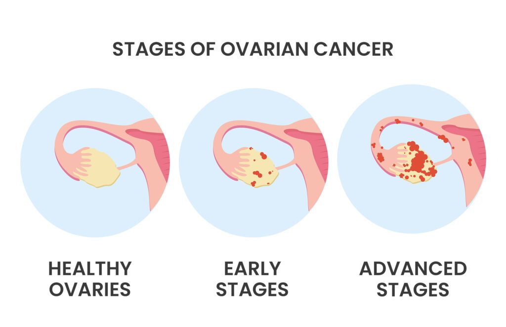 3 different stages of ovarian cancer, from healthy to advanced