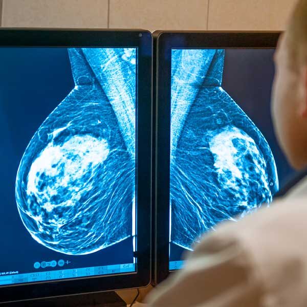 Mammograms, Ultrasounds and MRIs: What's the Difference?