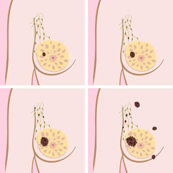 Breast-staging-Cancer-4-stages-2