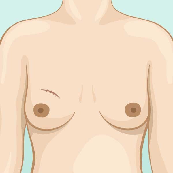 Breast-surgery-lumpectomy