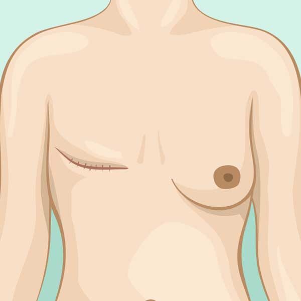 Breast-surgery-masectomy